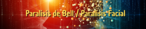 Mi paralisis de Bell